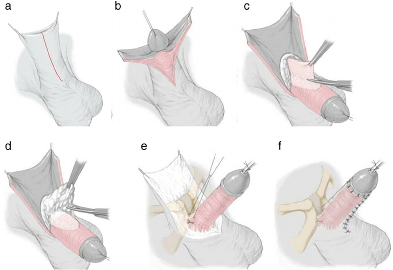 sphincterotomy for penis enlargement